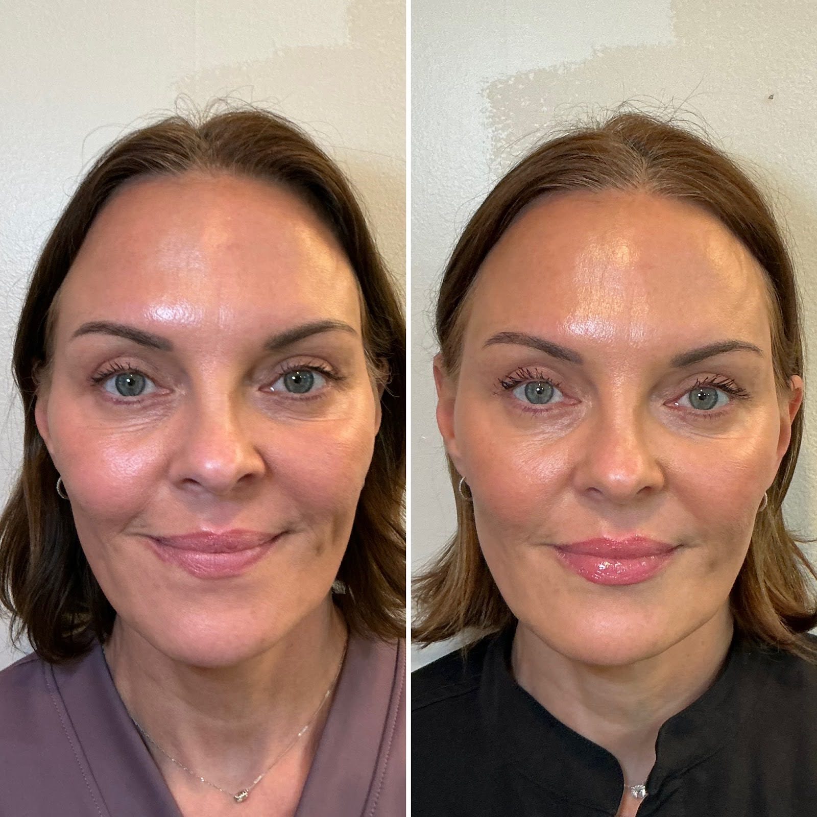 Temple Filler at Karee Hays