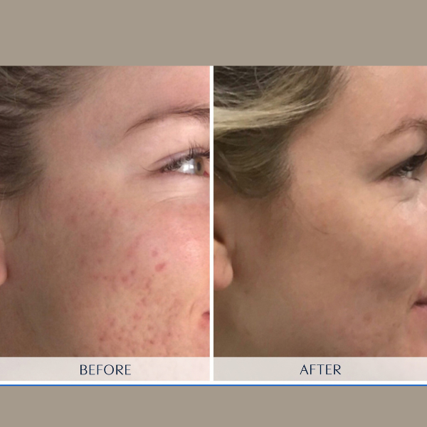 Microneedling