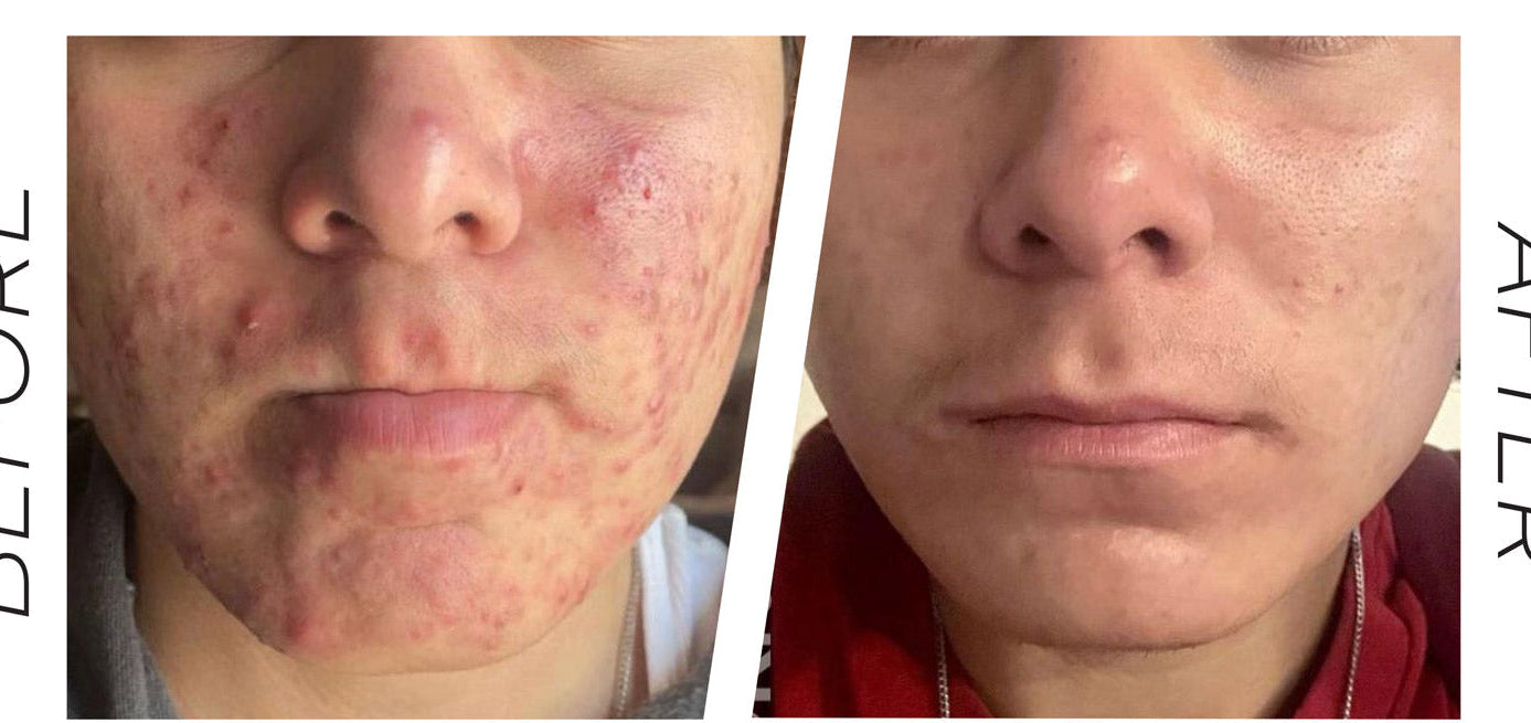 Before-and-after split comparison of a person's face showing acne improvement, labeled 'BEFORE' on the left and 'AFTER' on the right, with 'ACNE' text at the top and a small KraveMed courtesy line at the bottom.
