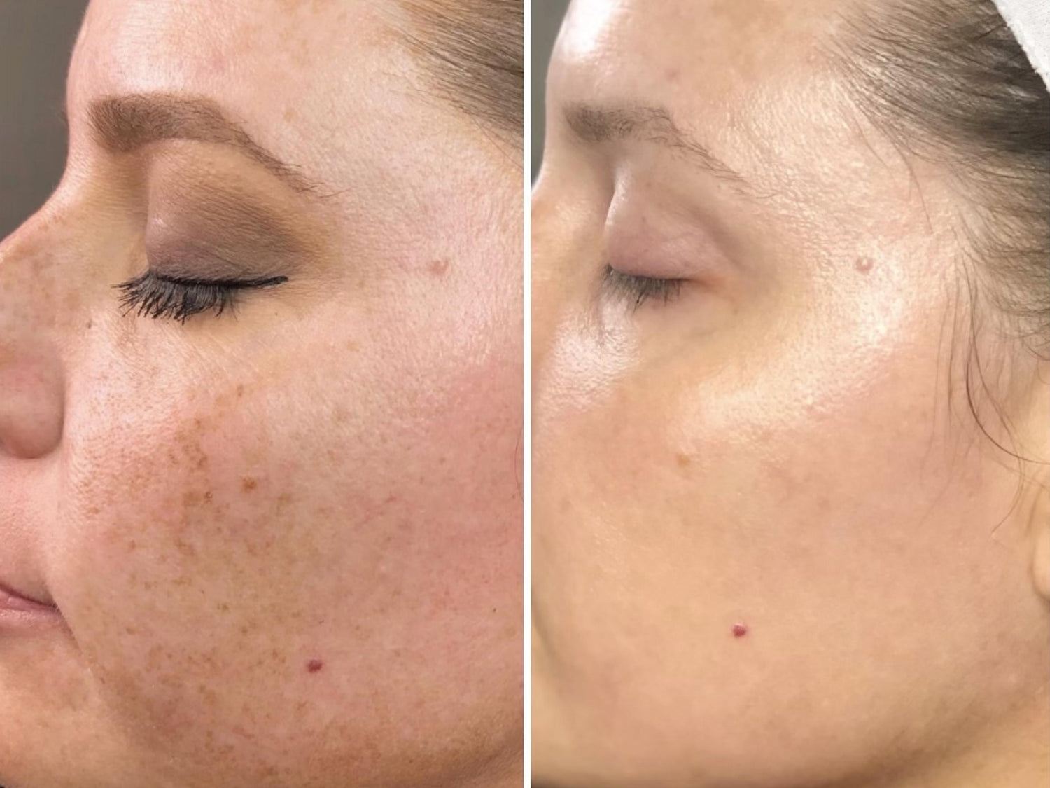 Before-and-after close-up side-by-side comparison of a woman's cheek, showing improvement in skin texture and reduction in visible freckles and hyperpigmentation.