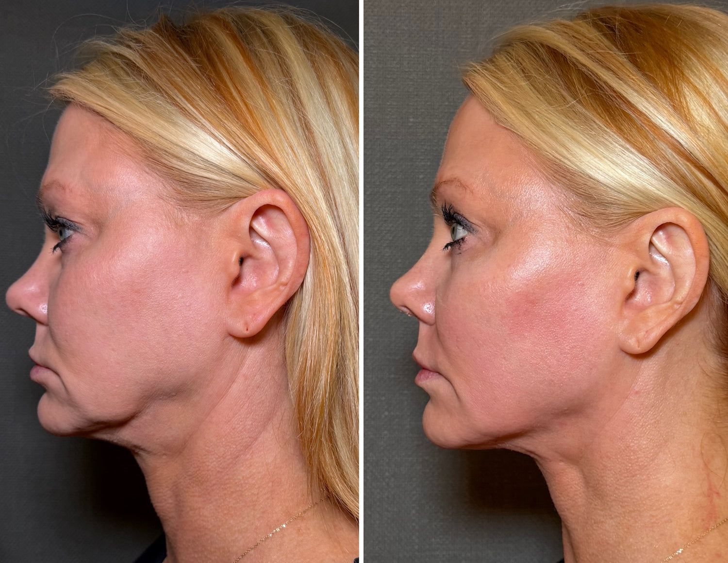 Before-and-after side-by-side comparison of a woman's profile, showing facial skin tightening and a reduction in sagging around the jawline and neck.